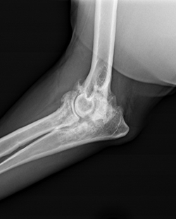 Arthritic elbow joint x-ray
