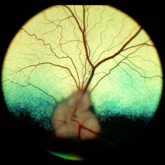 vision loss normal lens normal retina