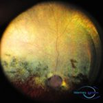 progressive retinal atrophy